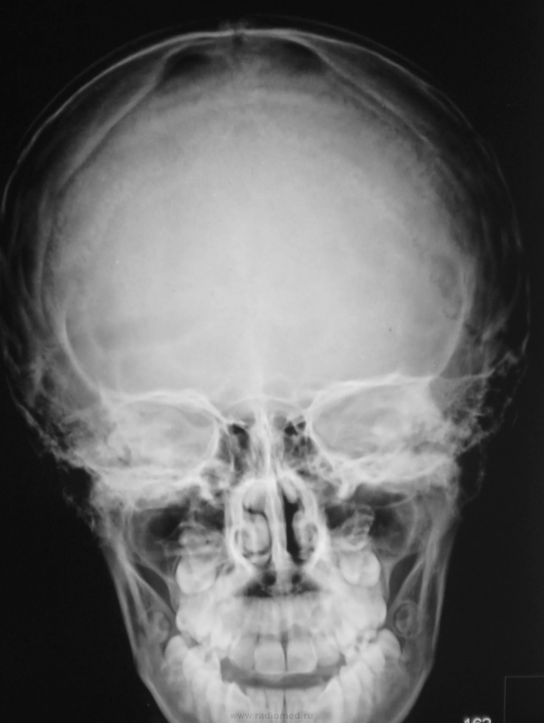 Рентген головы ребенка до года. Рентгеновский снимок головы. Снимок черепа новорождённого. Детский череп рентген