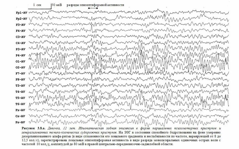 Что значит эпилептиформная активность. Эпилептиформные паттерны на ЭЭГ. Абсанс эпилепсия ЭЭГ. Эпилептиформные феномены на ЭЭГ что это. Острые волны на ЭЭГ.