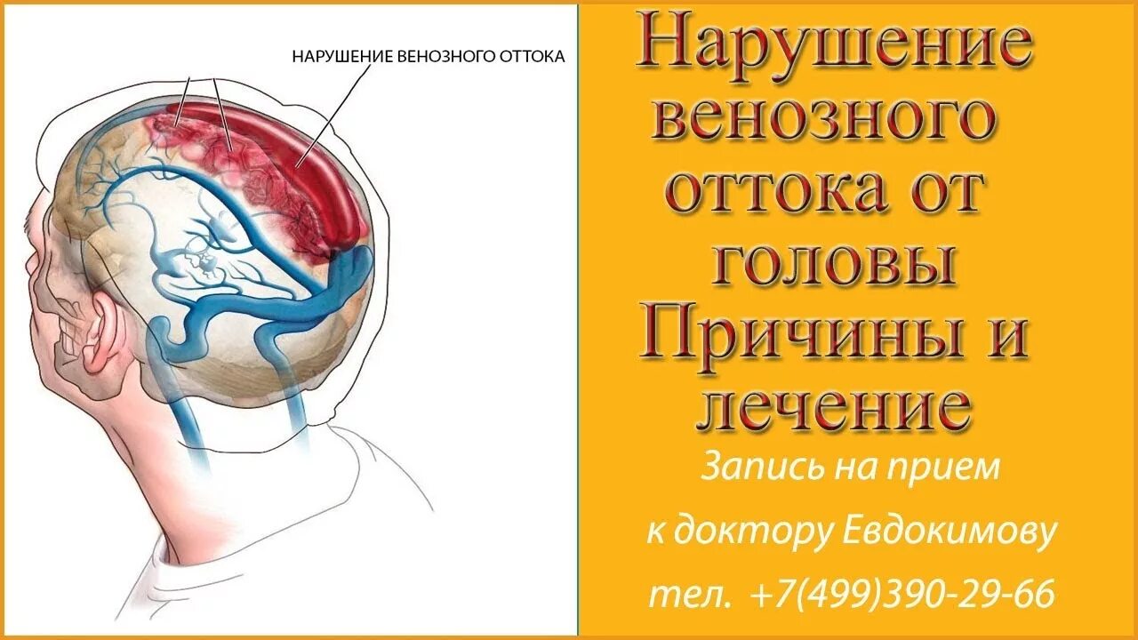 Венозный застой сосудов головного мозга препараты. Нарушение венозного оттока головы. Нарушение венозного оттока головного мозга. Венозный отток нарушен в голове. Венозная дисциркуляция головного мозга