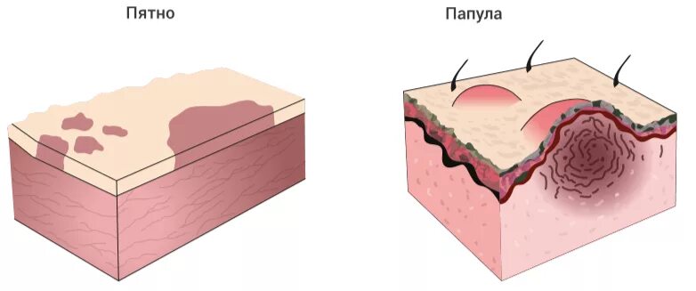 Образование пятен. Пятно папула везикула пустула язва.
