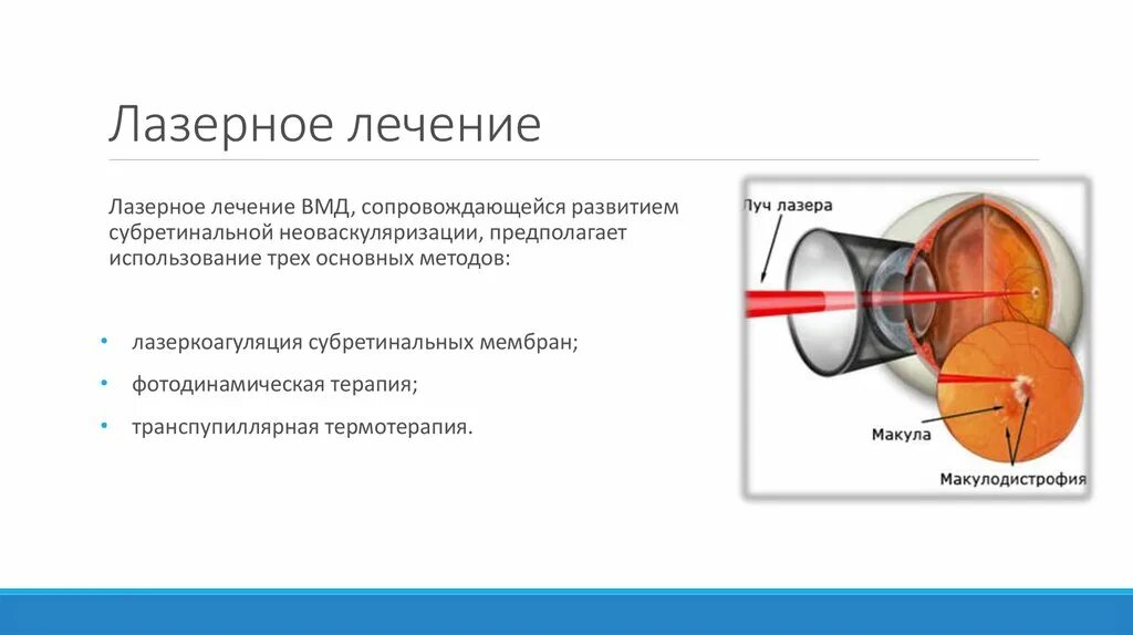 Лечение дегенерации макулы. Транспупиллярная термотерапия сетчатки. Возрастная макулярная дегенерация. Дегенерация макулы презентация. Возрастная макулярная дегенерация патогенез.