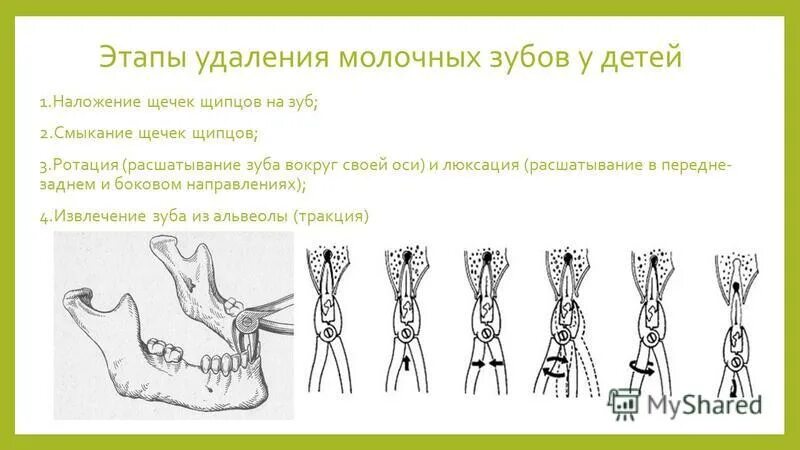 Этапы удаления молочных зубов. Этапы удаления молочного зуба. Удаление зуба этапы удаления.