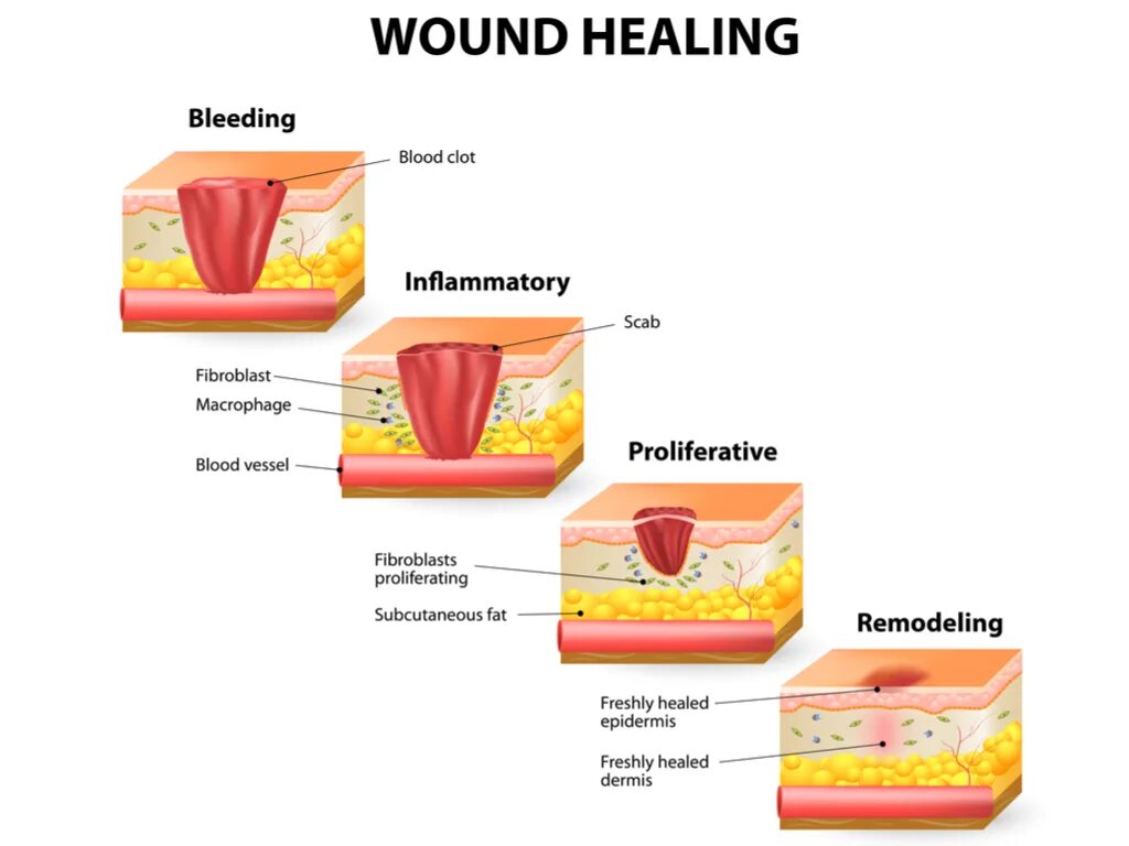 Через сколько заживает рана. Фазы заживления РАН схема. Стадии заживления РАН кожи. Процесс заживления РАН схема. Фазы заживления кожных РАН.