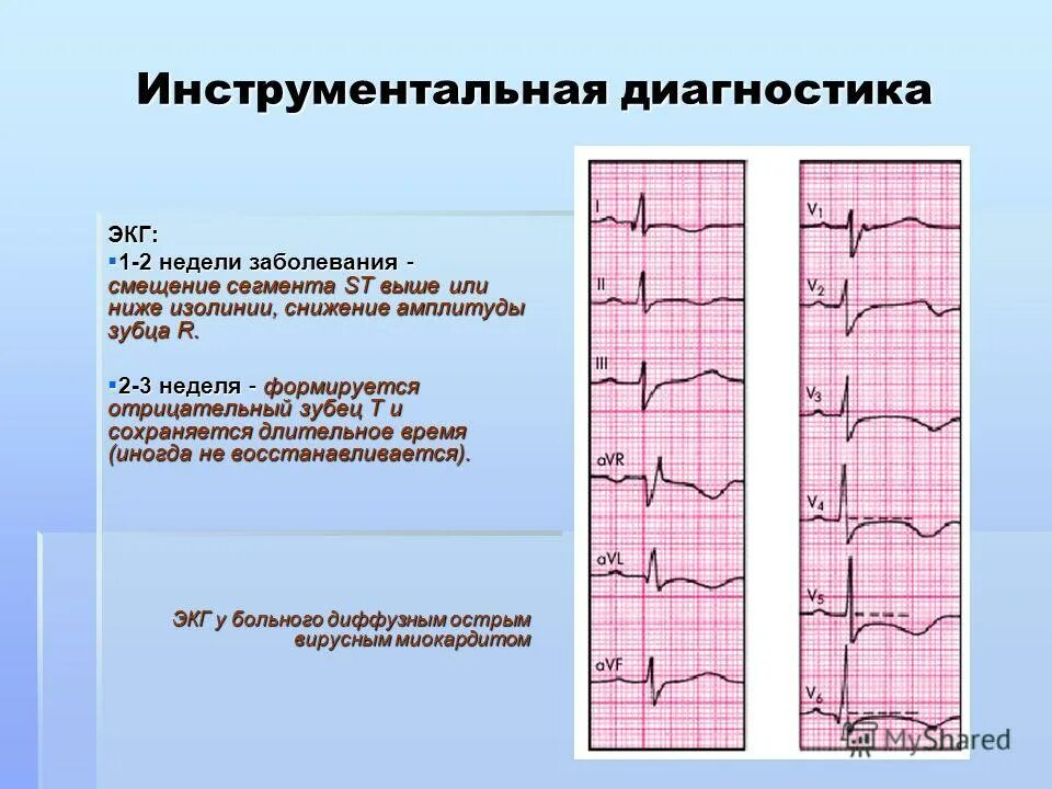 Диффузное поражение миокарда ЭКГ. Зубец s т на ЭКГ на изолинии. Выпадение зубца т на ЭКГ. Зубец т на изолинии диагноз. Диффузные изменения экг что это значит