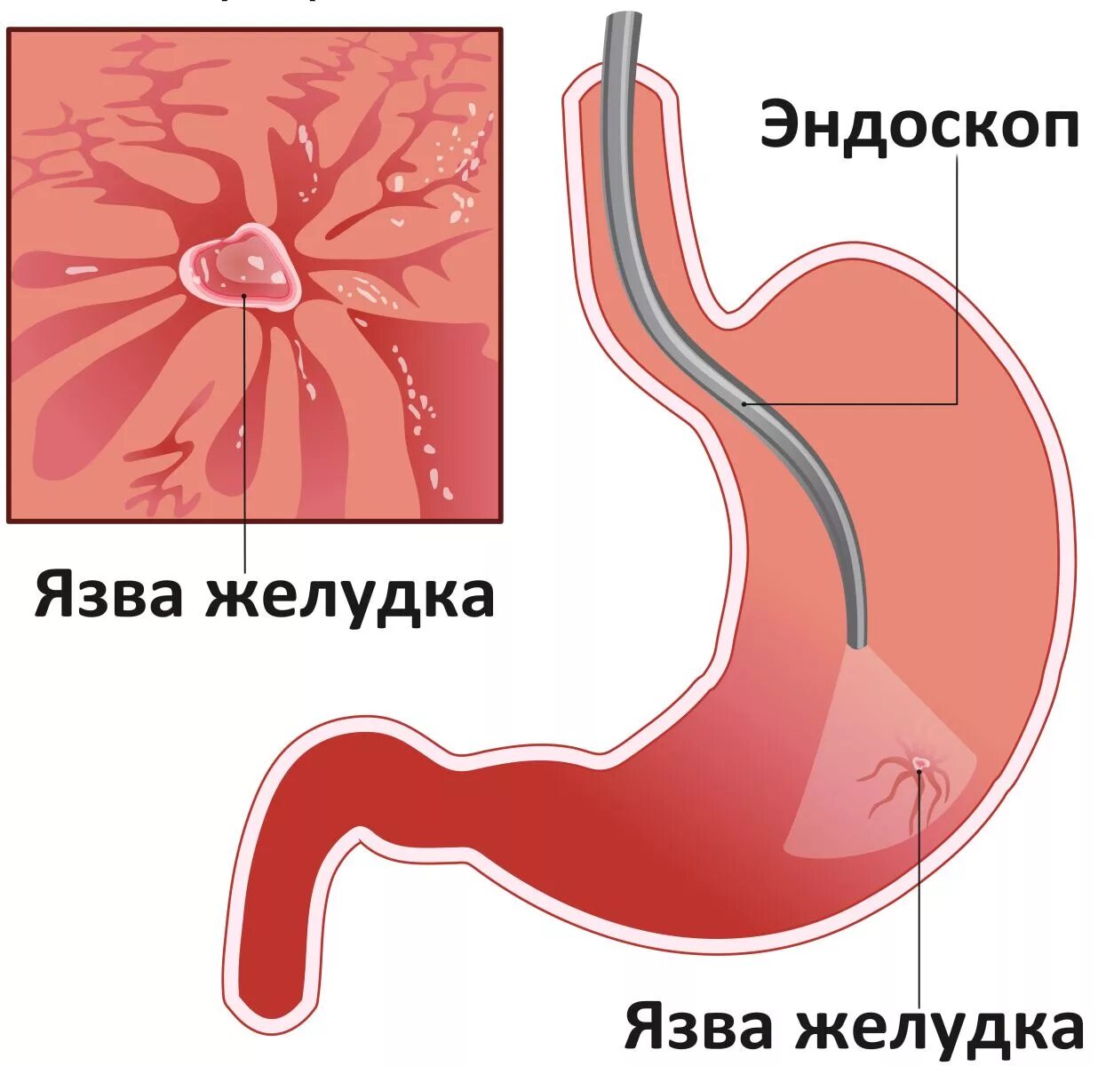 Язвенная болезнь желудка и язва желудка. Язвенная болезнь желудка эндоскоп. Язва двенадцатиперстной кишки ФГДС.