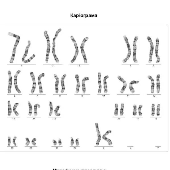 Кариотипирование супругов цена. Кариотипирование исследование. Кариотипирование примеры результатов. Кариотипирование Результаты анализов. Кариотипирование с аберрациями.