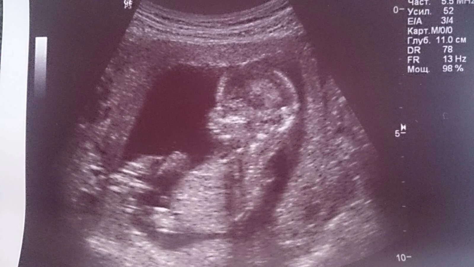 Ут детям. Снимки беременности. Снимок узи на 12 неделе. Беременность 3 м ребенком. Пол ребёнка в 12 недель на узи.
