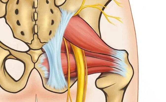 Сильные боли седалищного нерва. Седалищный нерв нерв. Защемление седалищного нерва анатомия. Седалищный нерв л5 с1. Неврит седалищного нерва.