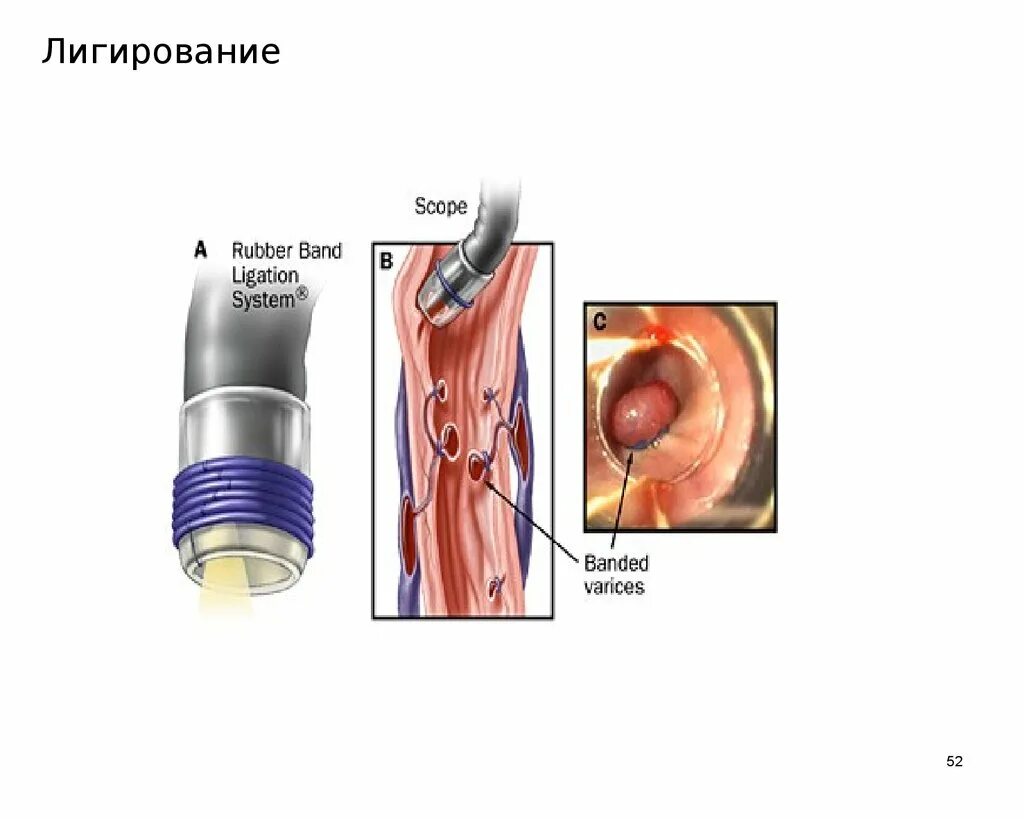 Лигирование латексными кольцами геморроидальных. Лигирование внутренних геморроидальных узлов. латексное лигирование геморроидальных узлов. лигирование латексными кольцами.