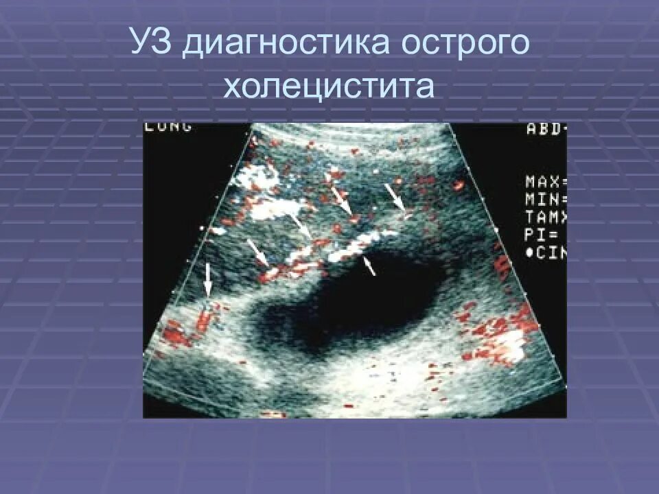 Острый калькулезный холецистит на УЗИ. Хронический калькулезный холецистит УЗИ. УЗИ картина холецистита. УЗИ диагностика острого холецистита.