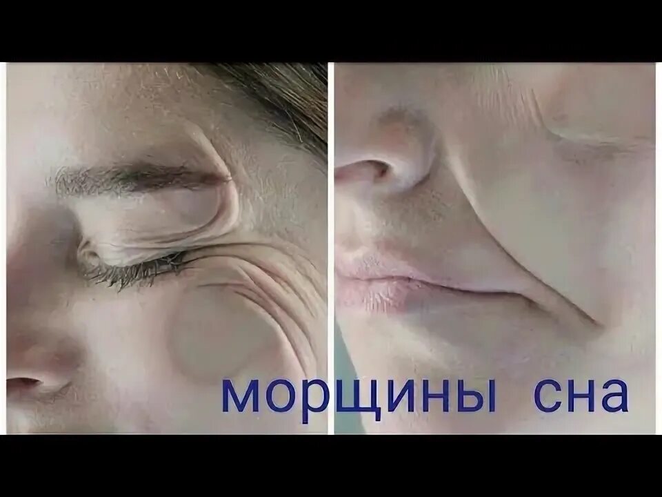 Как убрать морщины после 60. Морщины сна.