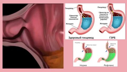 Рефлюкс эзофагит лечение у взрослых