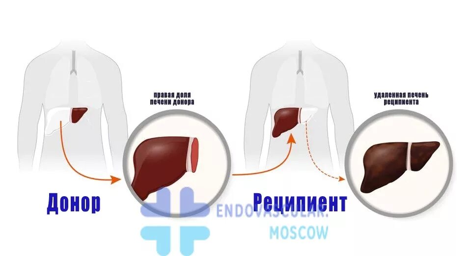 Печень после операции. Трансплантация печени. Трансплантология печени.