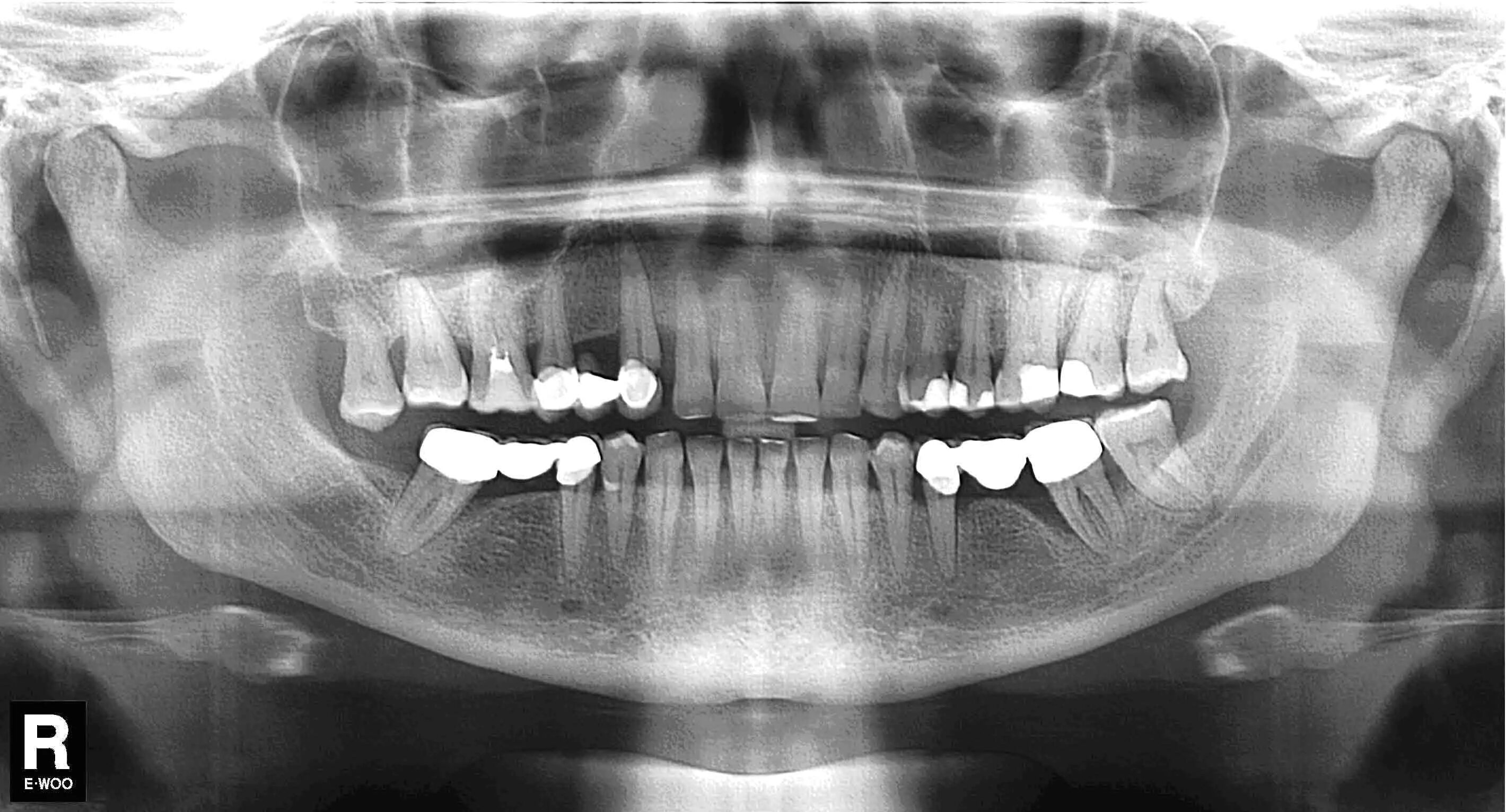 Снимок зубов видное. Ортопантомограмма челюсти. Ортопантомография пародонтит. Ортопантомограмма кариес.