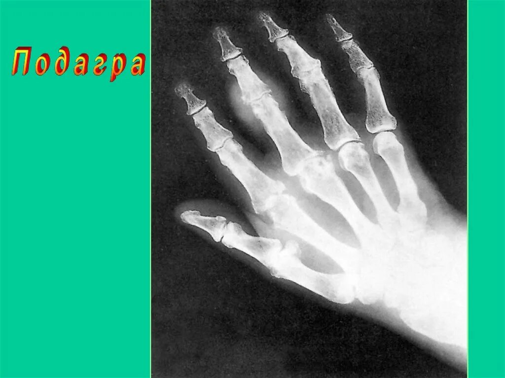 Тофусы рентген. Подагра 1 плюснефалангового сустава рентген. Подагрический артрит 1 пальца стопы рентген. Подагрические тофусы рентген. Подагра тофусы на кистях рук.