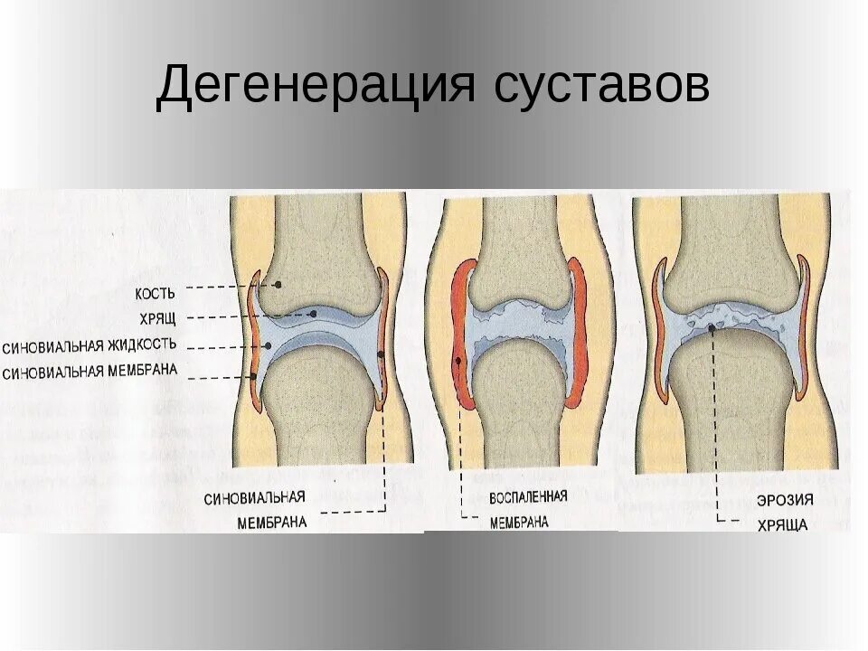 Изменение формы сустава. Дегенерация суставного хряща. Суставных хрящ надколенника. Дистрофия суставного хряща. Дегенеративные изменения суставов.