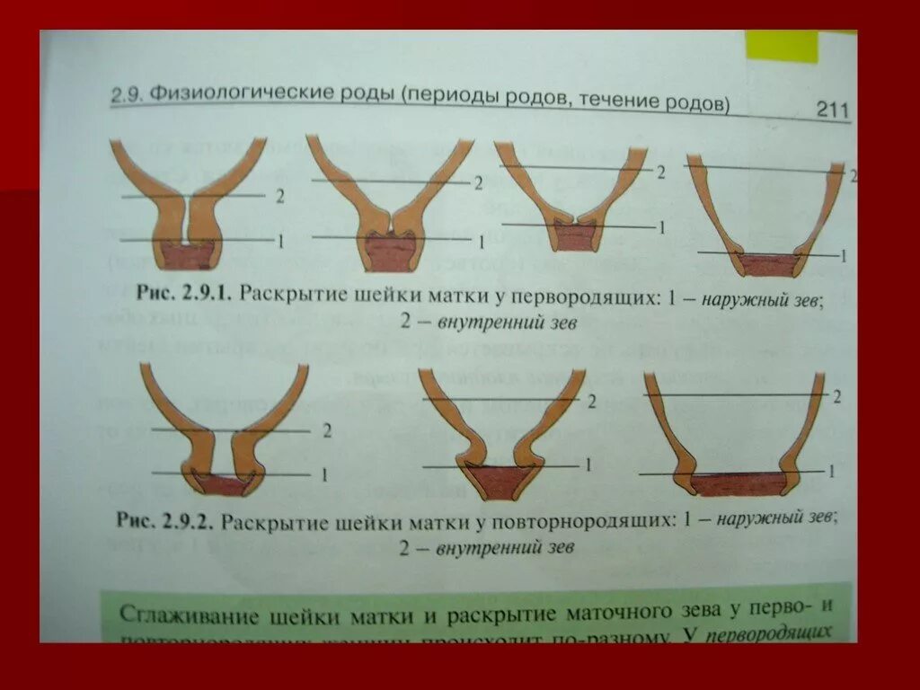 Роды 40 недель шейка не готова. Раскрытие шейки матки перед родами. Шейка матки перед родами. Раскрытие шейки матки в родах.