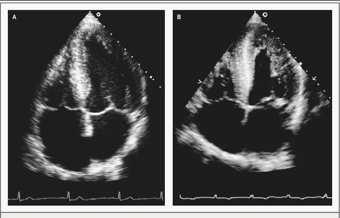 Тромб в желудочке. Гипертрофия правого желудочка ЭХОКГ. Аневризма межпредсердной перегородки эхокардиография. Аневризма МЖП на УЗИ. Гипертрофия левого желудочка на ЭХОКГ.