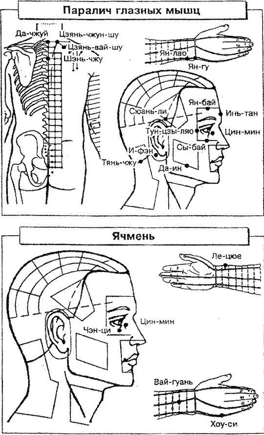 Экзофтальм птоз офтальмоплегия мидриаз. Internuclear ophthalmoplegia. Парез верхней косой мышцы глаза. Болезнь глаза птоз верхнего века. Экзофтальм птоз парез взора.
