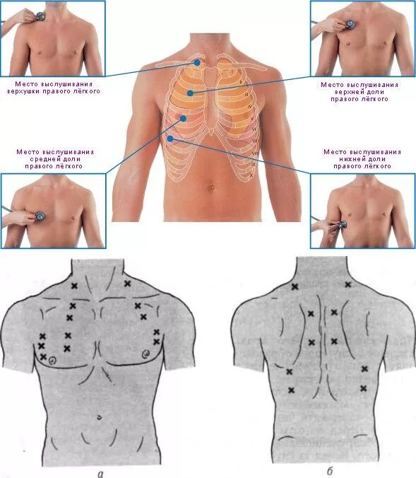 Аускультация легких точки выслушивания алгоритм. Точки аускультации легких у детей. Точки аускультации легких схема. Аускультация легких алгоритм точки.