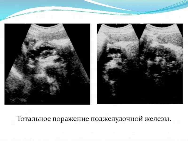 Диффузно дистрофические изменения поджелудочной. Ультрасонография поджелудочной железы. ультразвуковое исследование (узи) поджелудочной железы. узи поджелудочной железы. узи анатомия поджелудочной железы.
