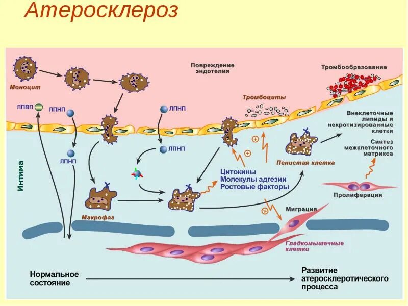Атеросклероз лпнп