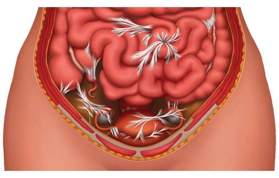 Боли в животе спайки. Спайки в брюшной полости. Спаечный процесс в брюшной.