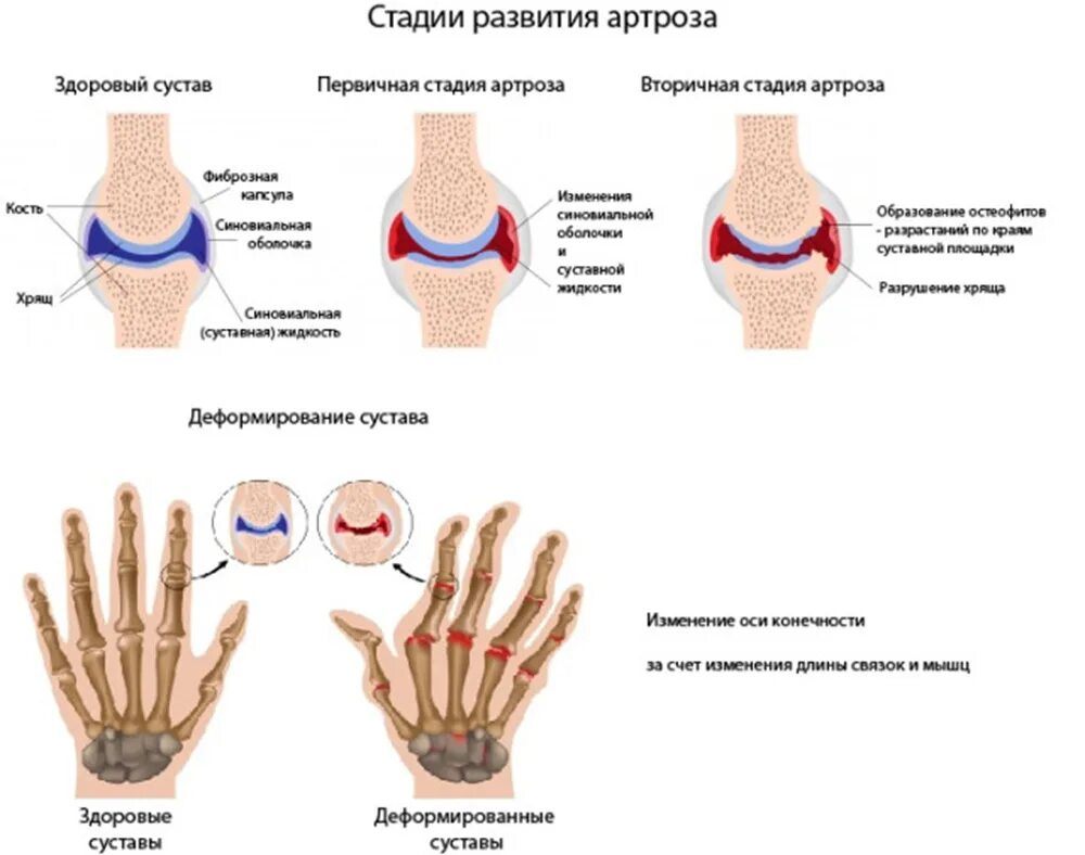 Схема развития деформирующего остеоартроза. Остеоартроз кистей деформирующий артроз. Артроз суставов кисти 3 степень. Остеоартроз пястно-фаланговых суставов. Болят суставы пальцев рук к какому врачу