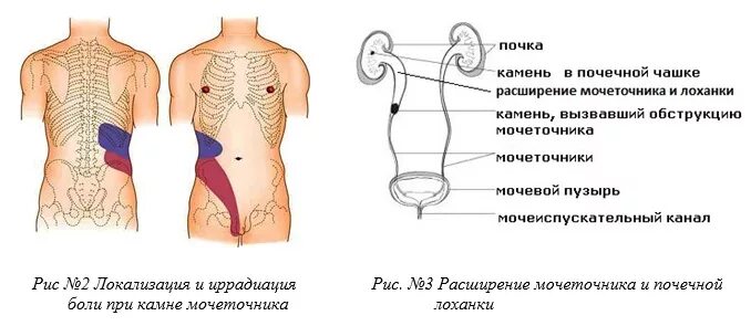Камень больно. Локализация боли при воспалении мочеточника. Локализация боли при Камне в мочеточнике. Локализация боли при заболеваниях мочеточников. Локализация боли при почечной колике.