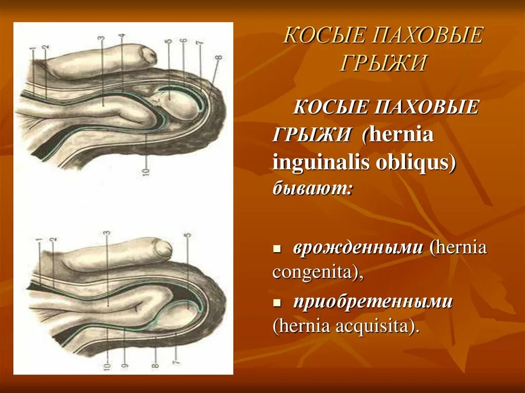 Косая паховая грыжа анатомия. Паховая грыжа локализация. Хирургическая анатомия врожденных паховых грыж. Прямая и косая паховые грыжи