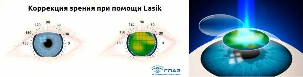 При какой близорукости делают лазерную коррекцию