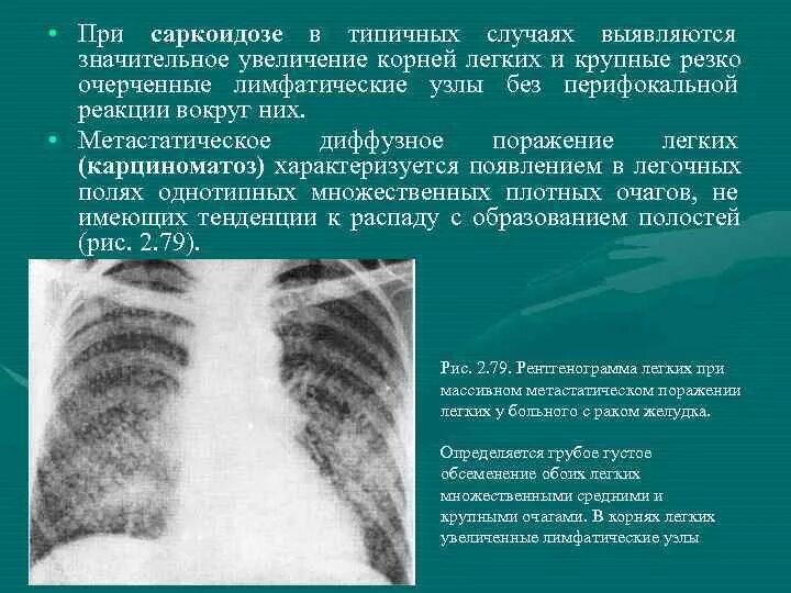 Описание снимка. Рентген стадии саркоидоза. Саркоидоз 1 стадия рентген. Саркоидоз легочная форма рентген. Саркоидоз легкого рентген.