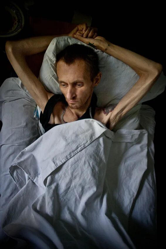 лица больных вич. лица больных вич. человек больной туберкулезом. люди больные туберкулезом. вич инфицированные женщины.