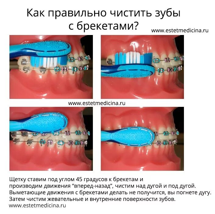 Как чистить зубы с брекетами щеткой. Алгоритм чистки зубов с брекетами. какчистить субы с брекетамт.