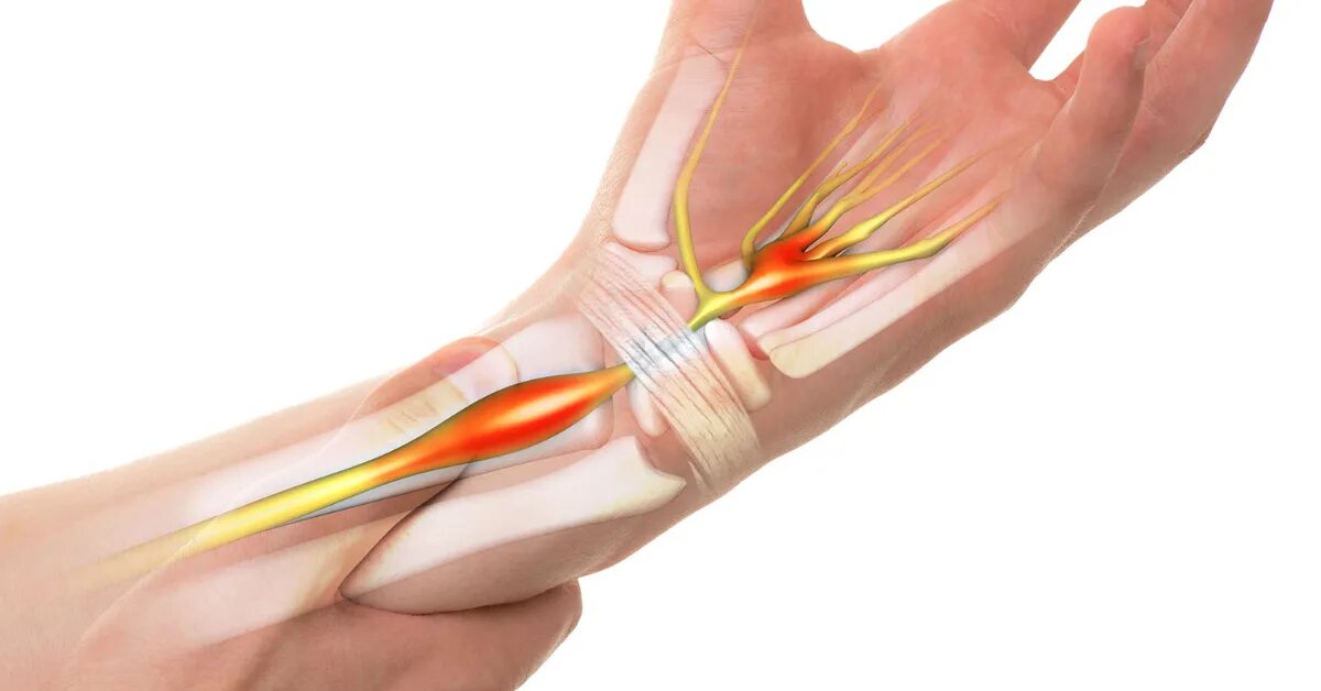 Повреждение лучевого нерва при переломе. Защемление локтевого сустава симптомы. Туннельный синдром локтевого нерва. Туннельный синдром локтевого нерва. Туннельный синдром локтевого нерва блокада.