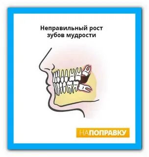 Удаление тройничного нерва зуба