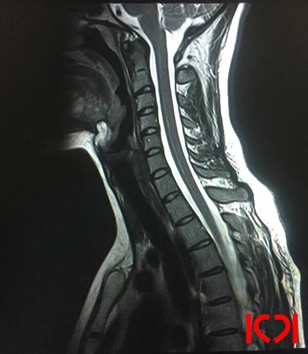 Мрт шейного отдела позвоночника по времени. Мрт шейного отдела позвоночника. Мрт шейного отдела позвоночника норма. Мрт шейного отдела норма. Мрт шейного отдела позвонка.