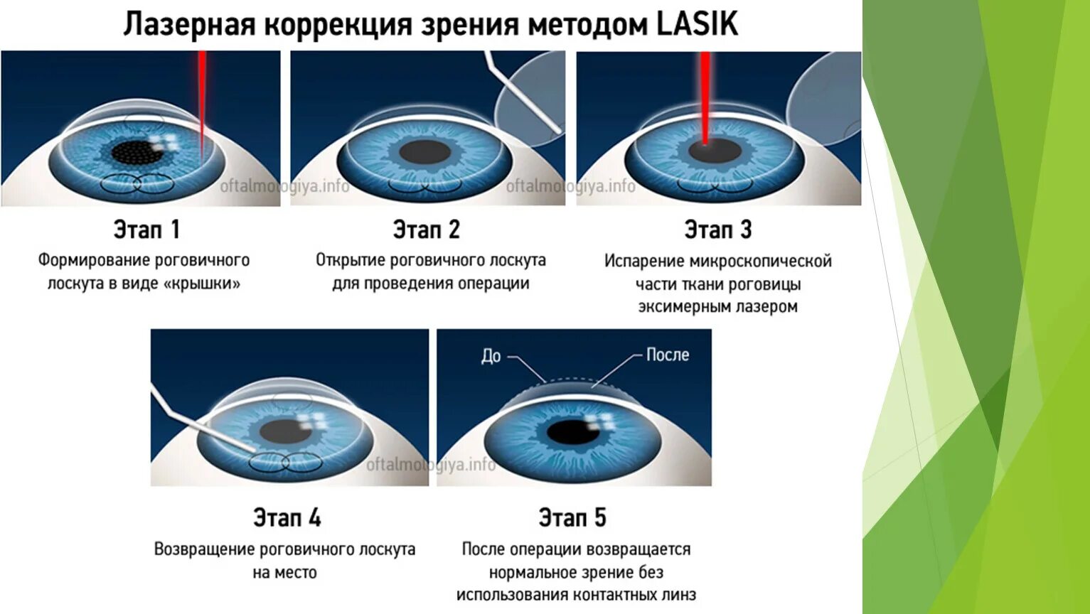 Тончайшее отличие. LASIK лазерный кератомилез. Коррекция зрения лазером методом ласик. Лазерная коррекция зрения Фемто ласик. Лазерная коррекция методом Фемто ласик.