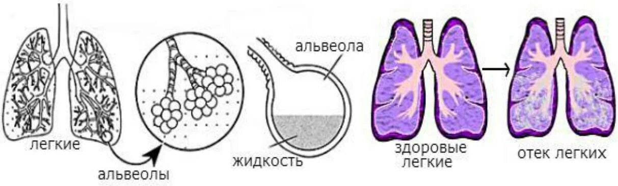 Альвеолярный отек легких. Легкие заполненные водой