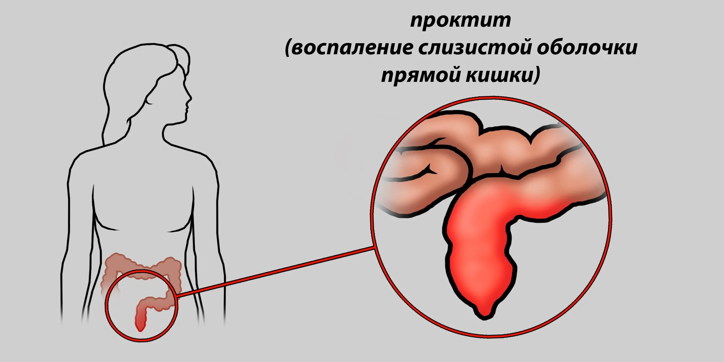 Трещина в кишечнике. Воспаление прямой кишки. Воспаление прямой кишки (проктит). Воспаление слизистой прямой кишки.