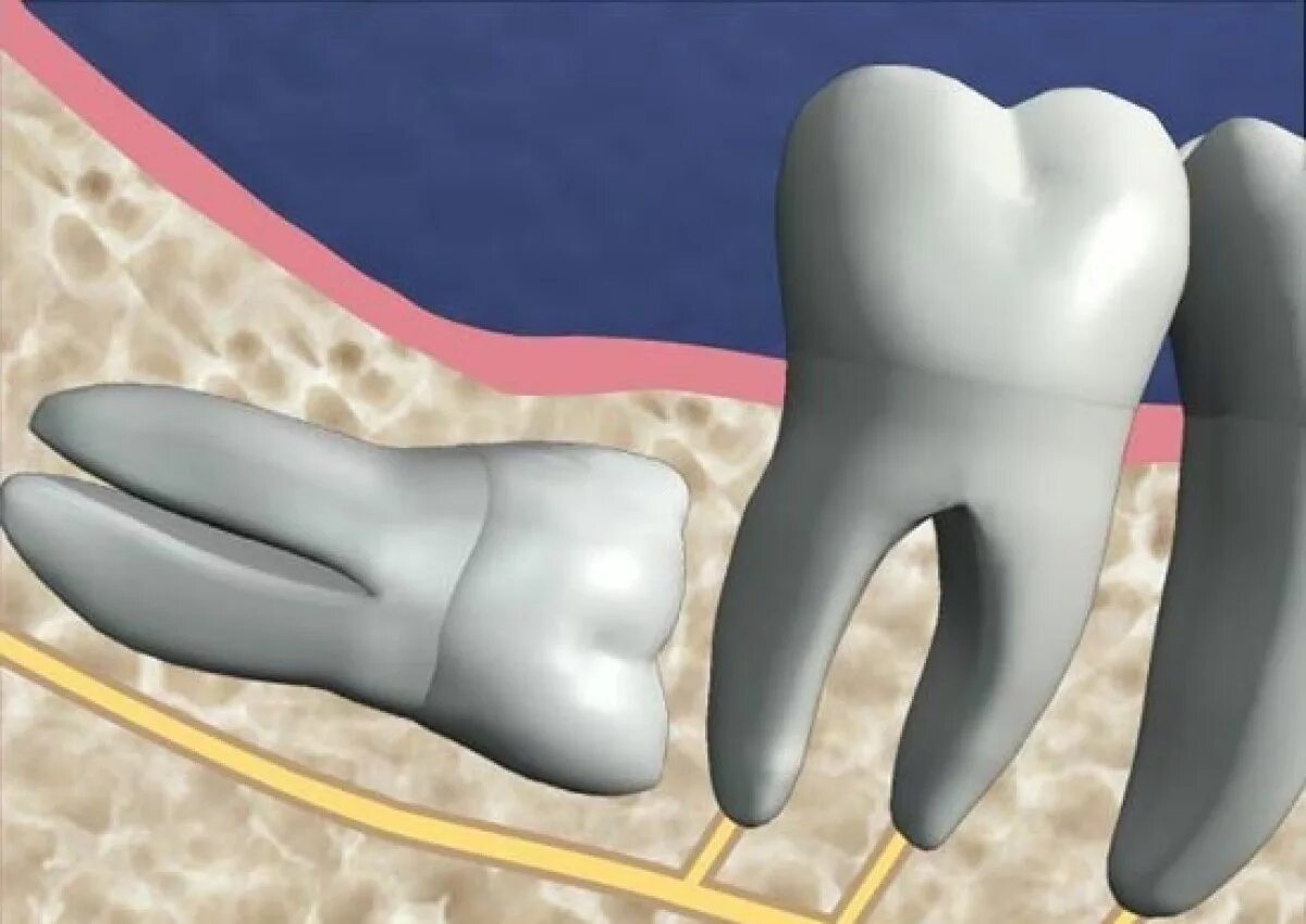 Сложное удаление зуба. Ретинированный зуб мудрости. Ретинированный дистопированный зуб мудрости. Ротироваррый зуб мудрости. Ретинированный зуб мудрости снимок.