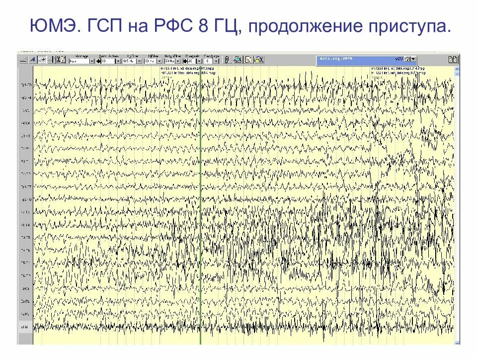 Ээг характеристика. Юношеская миоклоническая эпилепсия ЭЭГ. ЭЭГ при юношеской миоклонической эпилепсии. Инвазивный ЭЭГ мониторинг при эпилепсии. ЭЭГ паттерны юношеской миоклонической эпилепсии.