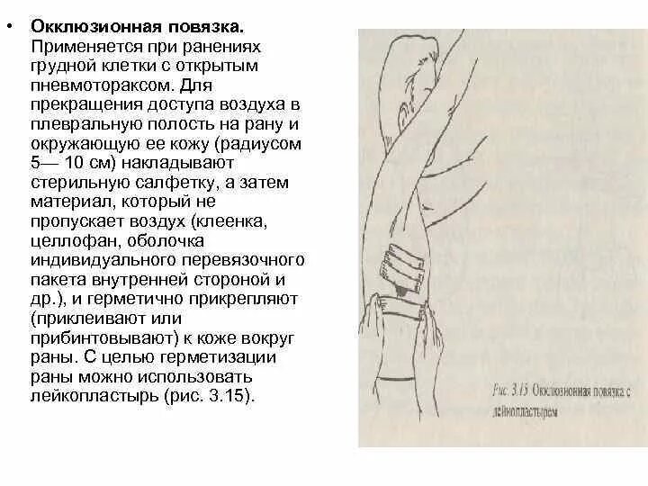 Техника наложения окклюзионной