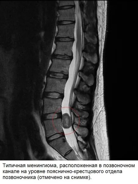 Межпозвоночная грыжа мрт. Менингиома позвоночника мрт. Менингиома поясничного отдела позвоночника мрт. Киста спинного мозга поясничного отдела. Киста в пояснице