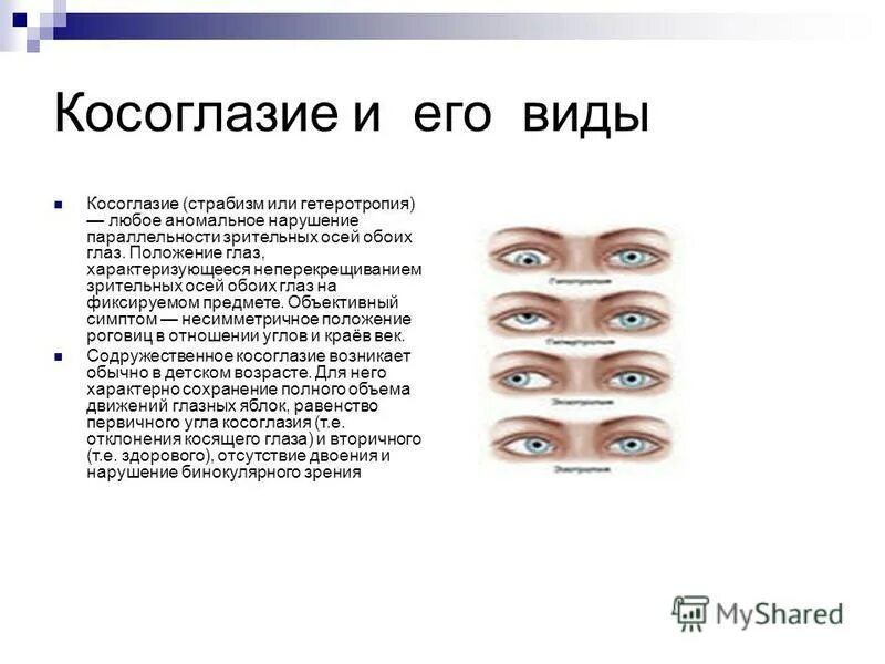 бинокулярное зрение и косоглазие. при обработки глаз какое положение. оказание первой помощи при ранении глаз. профилактика при косоглазии. при обработки глаз какое положение.