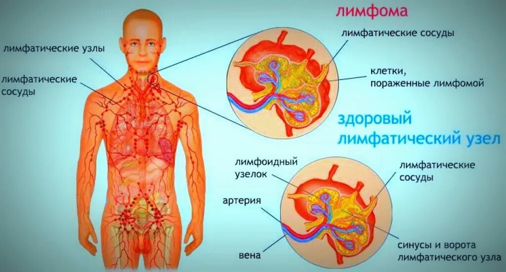 Метастазированные лимфоузлы. Метастазирование в лимфоузлы. Метастатические опухоли лимфатического узла. Метастазы в лимфатические узлы.