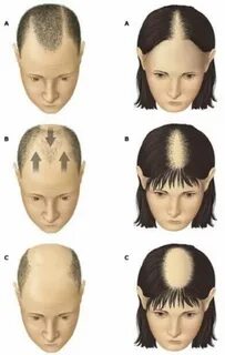 Андрогенная алопеция это