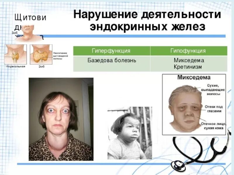 Какие признаки эндокринных заболеваний. Заболевания вызванные пониженной функцией эндокринных желез. болезнь эндокринной системы щитовидная железа. заболеванияэдокринойсистемы. болезни при нарушении желез внутренней секреции.