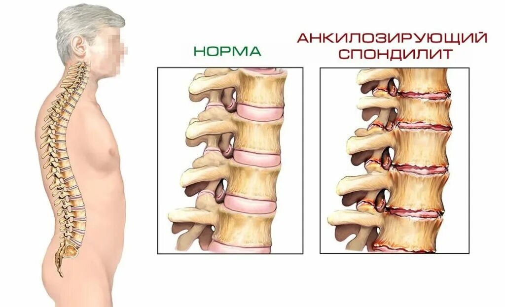 Анкилозирующий спондилит болезнь Бехтерева. Анкилозирующий спондилез это болезнь Бехтерева. Спондилит анкилозирующий поясничного отдела позвоночника. Спондилоартроз болезнь Бехтерева.