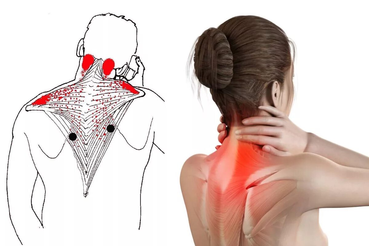 Что делать если больно поворачивать. Боль в шее. Болят мышцы шеи. Ременная мышца головы триггерные точки.